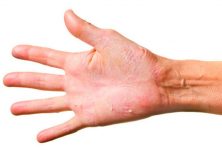 Rituximab es prometedor para el tratamiento de dermatitis herpetiforme
