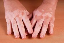 Características clínicas de vitiligo relacionadas a la edad de aparición de la enfermedad