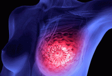 Eficacia y seguridad de Enzalutamida más Transtuzumab en pacientes con cáncer de mama