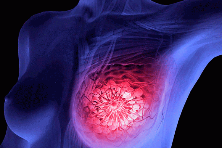 Eficacia y seguridad de Enzalutamida más Transtuzumab en pacientes con cáncer de mama