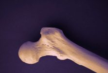 ACP: Recomendaciones actualizadas para el tratamiento de baja densidad ósea