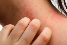Avances recientes en el conocimiento de la patogénesis de la dermatitis atópica