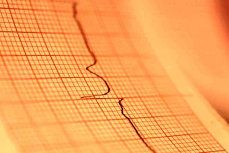 Los factores de riesgo explican la mayor parte del riesgo de insuficiencia cardíaca en la incidencia de fibrilación atrial