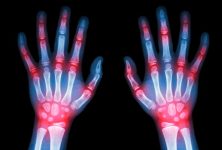 Ciertos criterios pueden ser mejores que otros en la evaluación de la artritis reumatoide