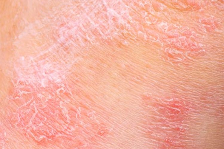 Dermatitis atópica: la enfermedad impulsada por citoquinas y sus nuevos desarrollos terapéuticos