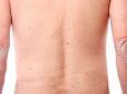 Durabilidad de la respuesta en pacientes con psoriasis en placas tratados con certolizumab pegol