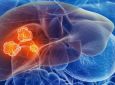 Nivolumab en el tratamiento del cáncer de hígado