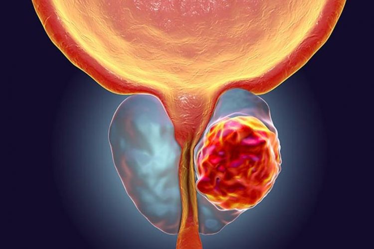 Avances en el tratamiento del cáncer de próstata resistente a la castración.