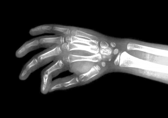 Eficacia y pautas de tratamiento de la monoterapia con tofacitinib en pacientes con AR: contextualización de los resultados de ensayos controlados aleatorios con datos del mundo real.